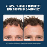 Nutrafol Men before and after hair appearance